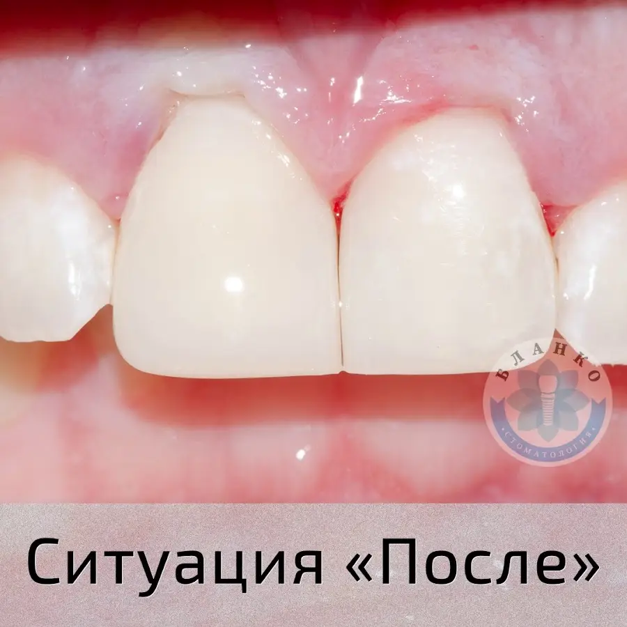 Стоматология &laquo;Blanco&raquo; &mdash; Днепр | Лечение Зубов Под Микроскопом | Имплантация зубов | Протезирование зубов | Оплата частями ( кредит на лечение, рассрочка от ПриватБанка ) | Гарантия